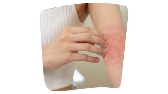 Donna con sintomi visibili di dermatite da contatto sul braccio causata dall’uso di un cerotto inadeguato. Donna con sintomi visibili di dermatite da contatto sul braccio causata dall’uso di un cerotto inadeguato.